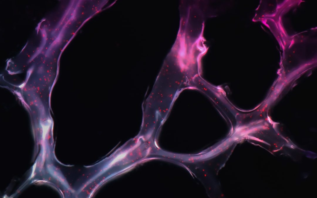 Photo Pancreatic cancer
