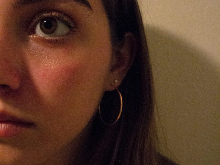 Photo "deep pimple"