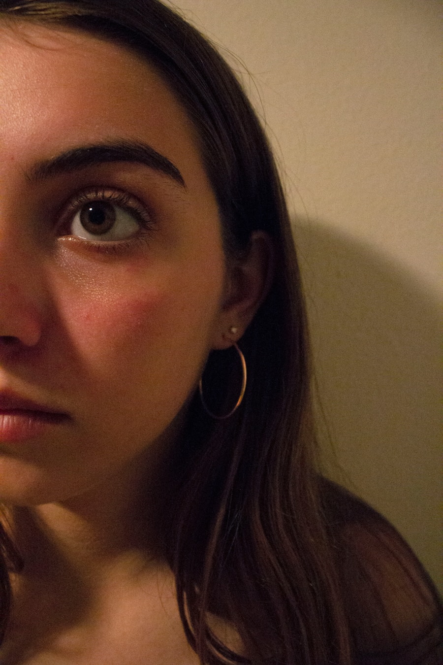 Photo "deep pimple"
