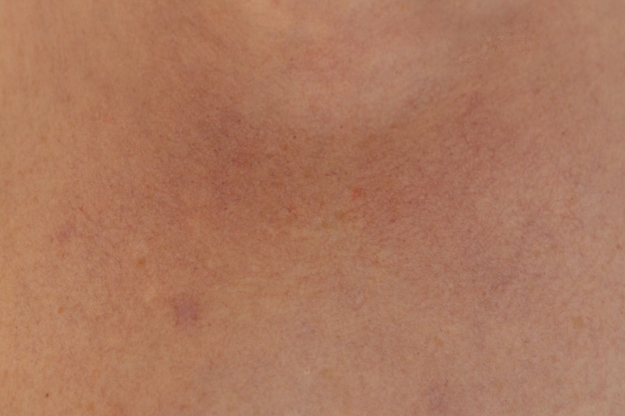 Photo Cystic acne