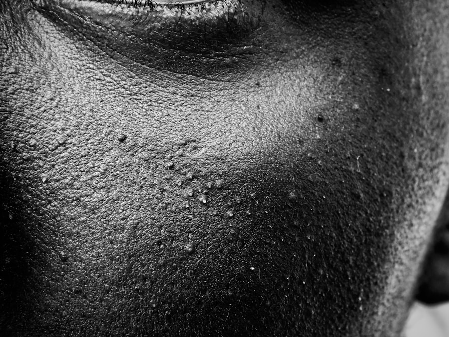 Photo "skin symptoms of AIDS"