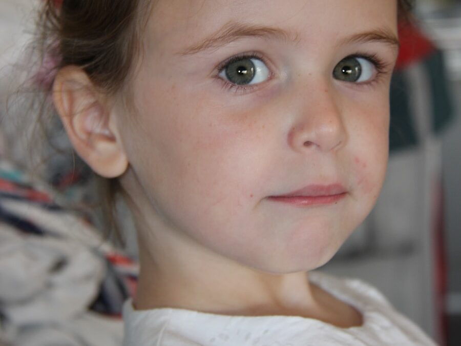 Photo Treatment of Alport syndrome