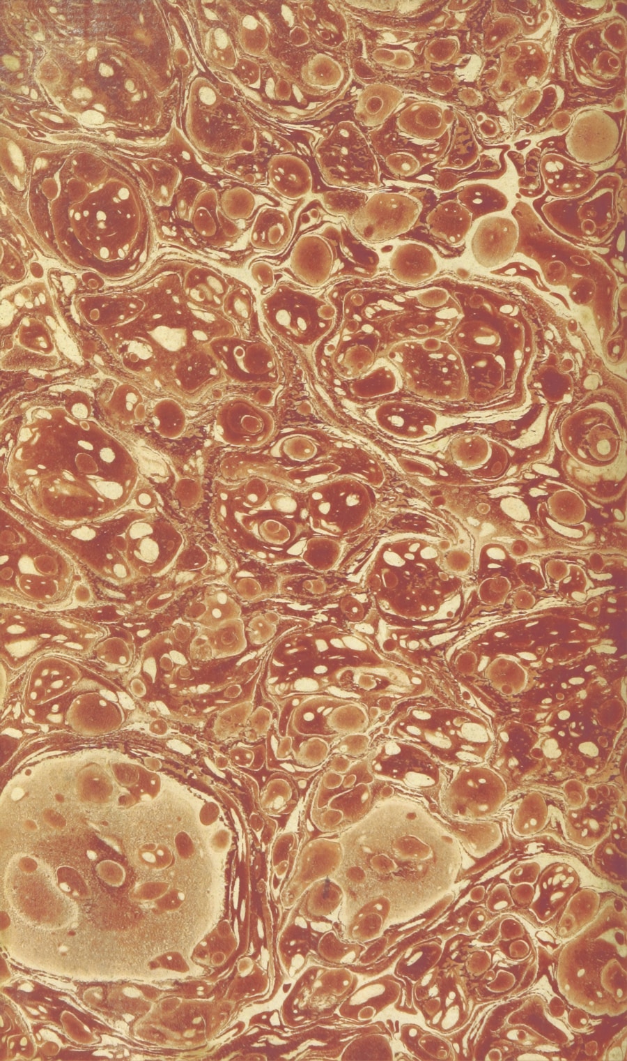 Photo "Diagnosis of amyloidosis"