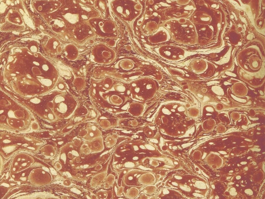 Photo Bartholins cyst inflammation