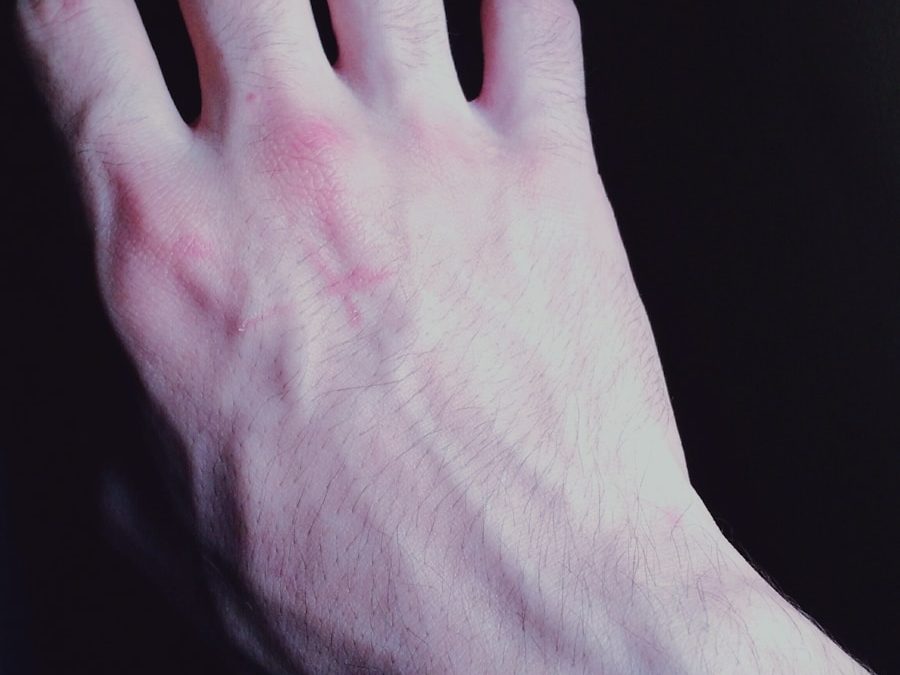 Photo "Bartholin cyst pain"
