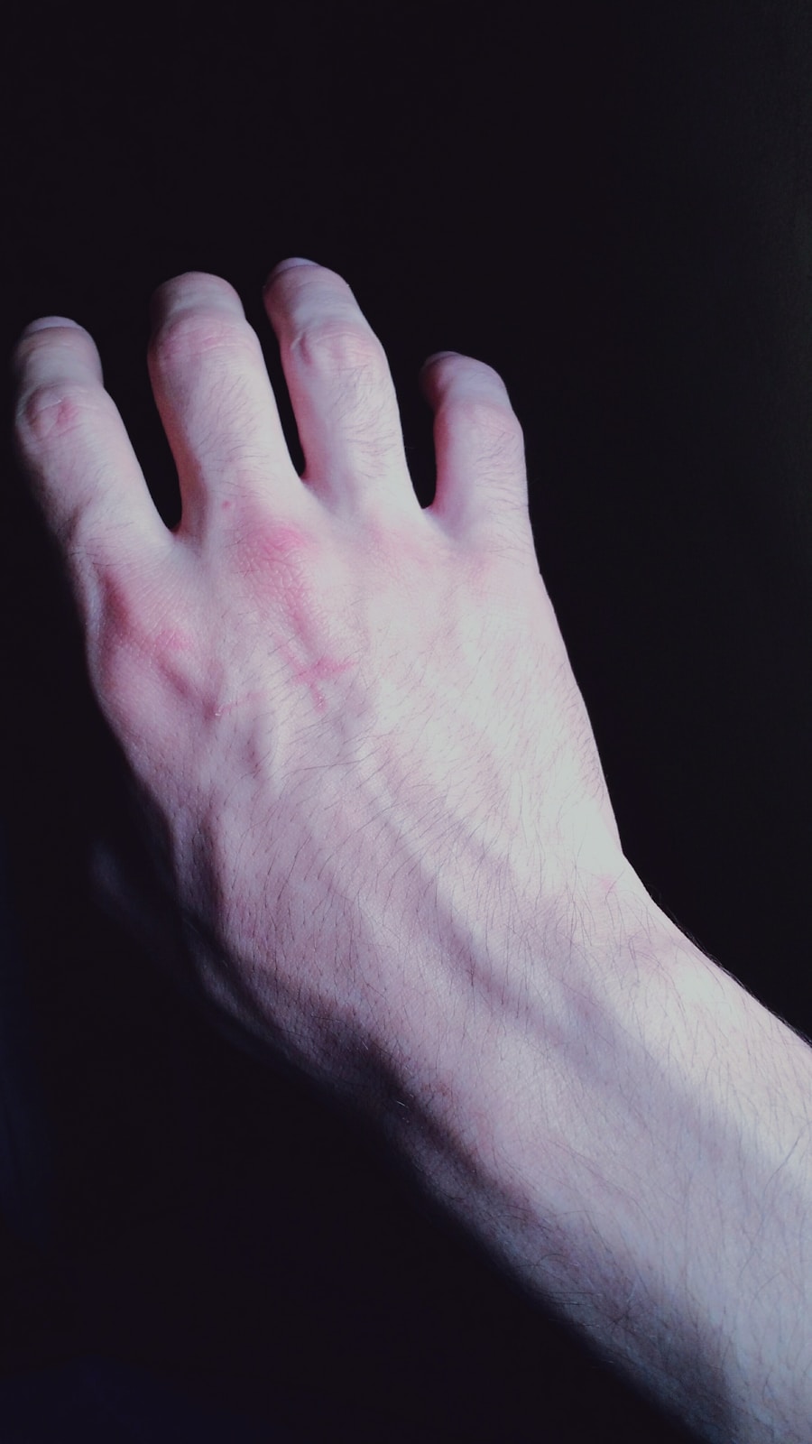Photo "Bartholin cyst pain"