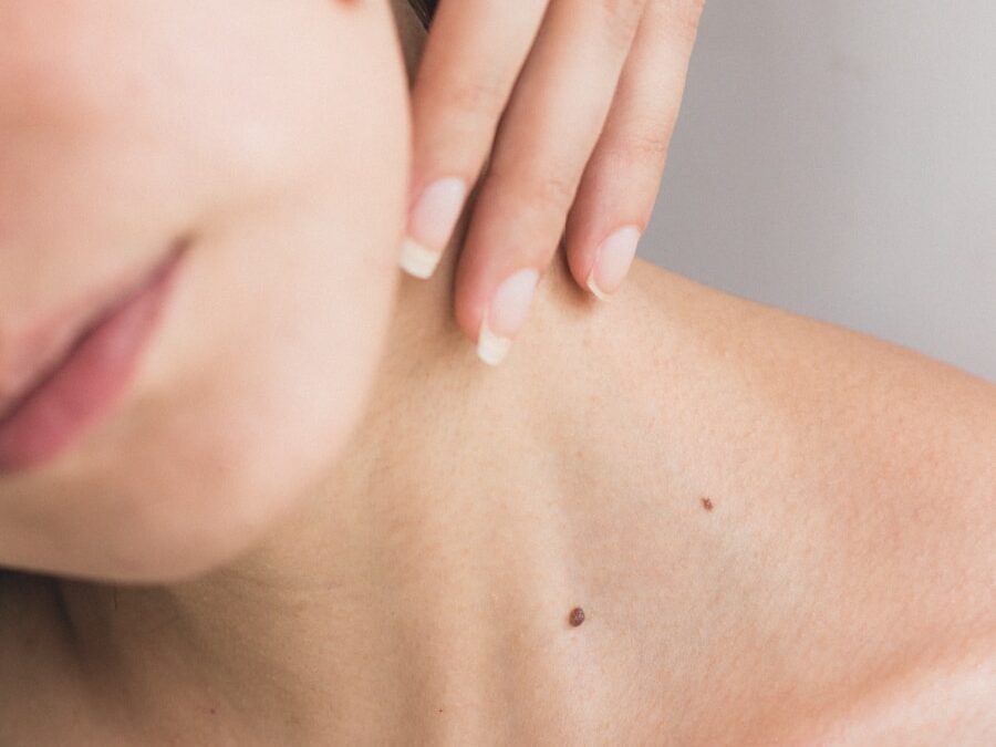 Photo Removal of birthmarks