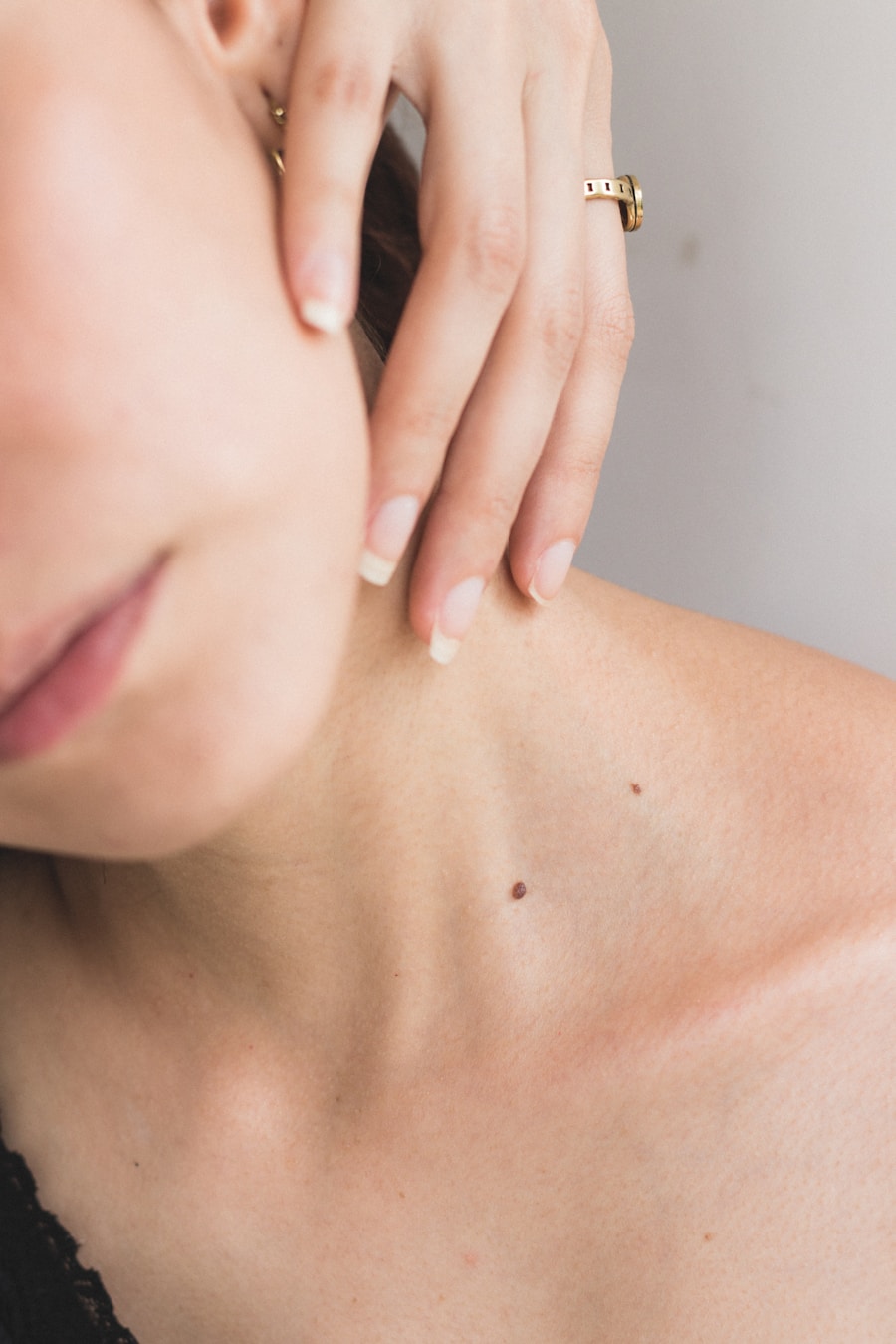 Photo Removal of birthmarks