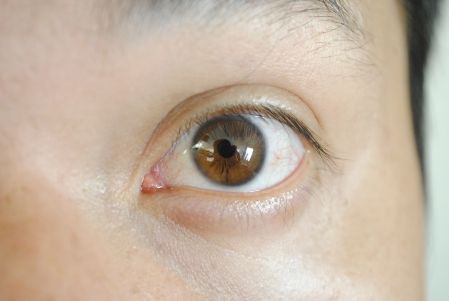 Photo Treatment of astigmatism