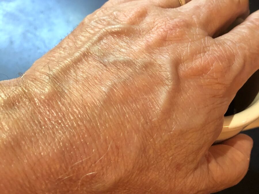 Photo Carpal tunnel syndrome surgery