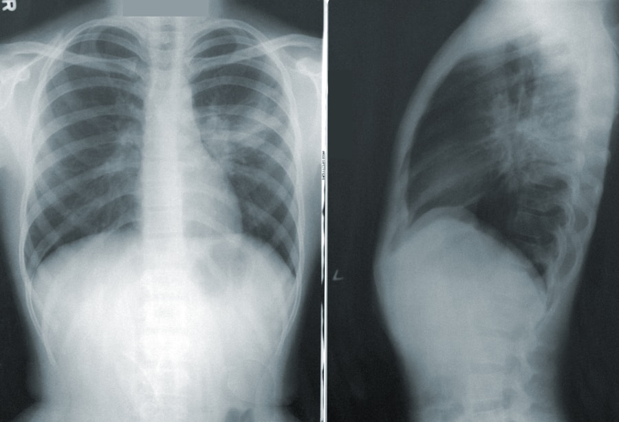 Photo Diagnosis of atelectasis