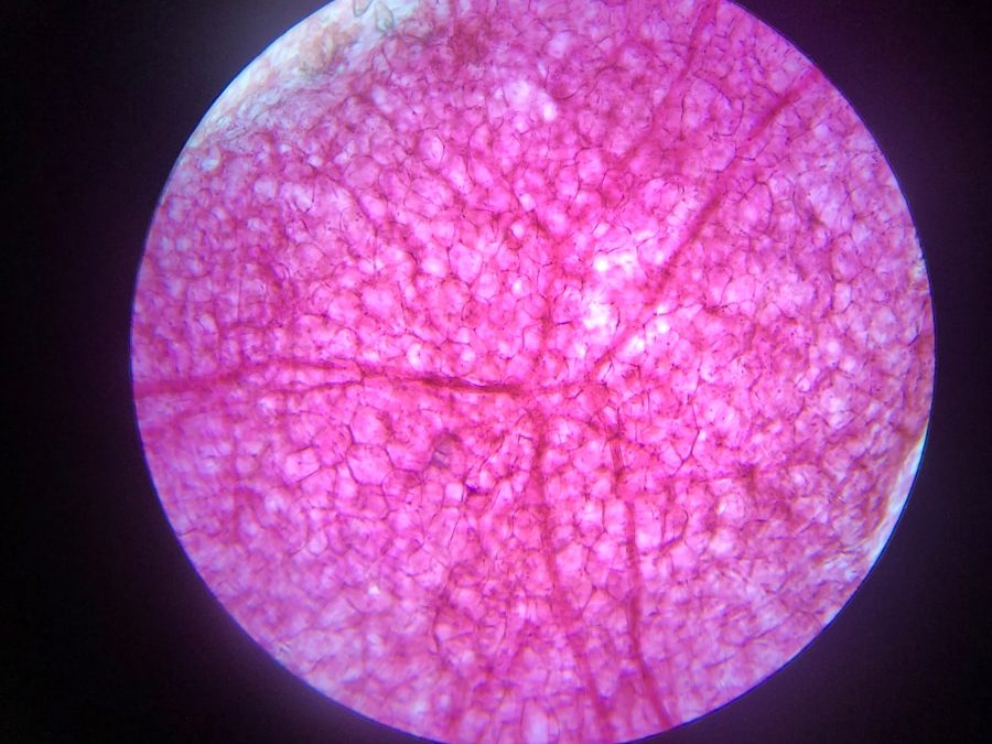 Photo "Types of atelectasis"