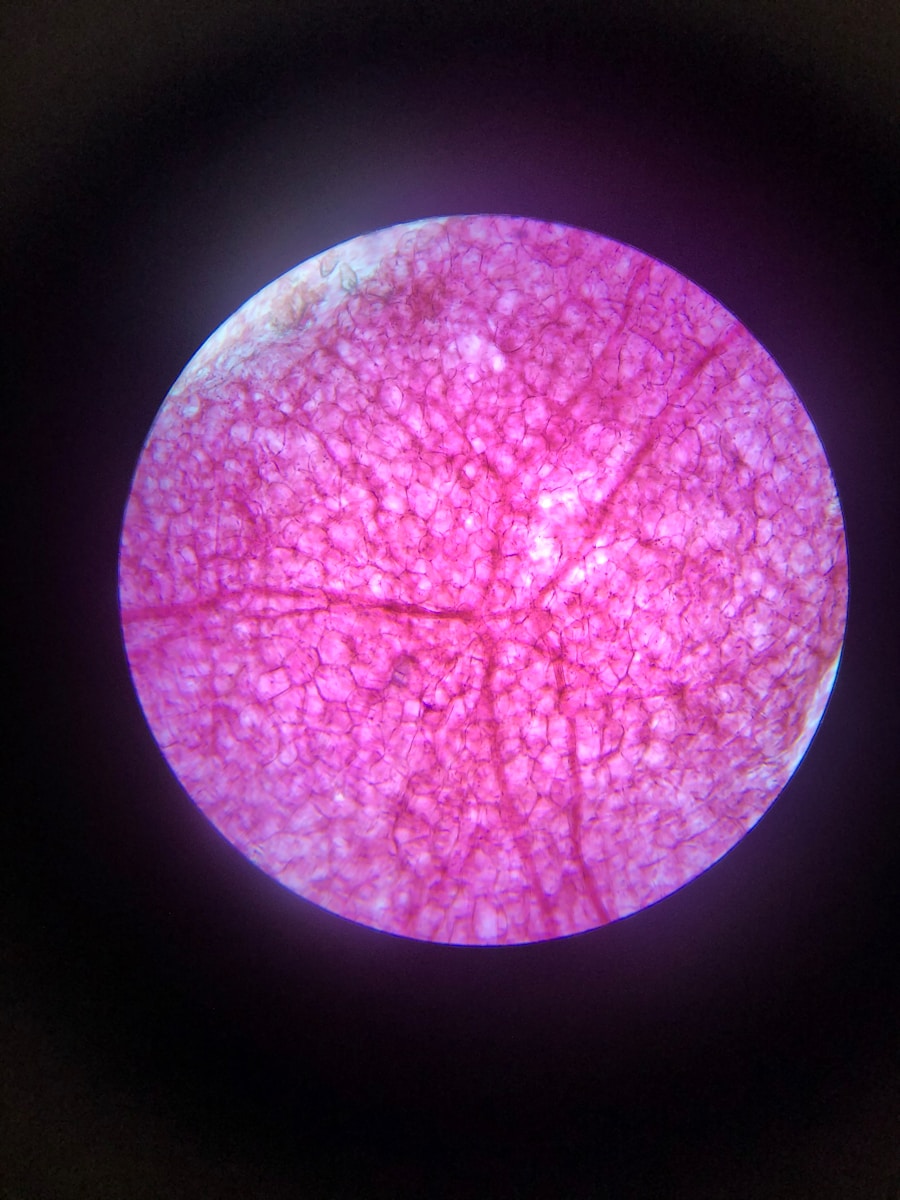 Photo "Types of atelectasis"