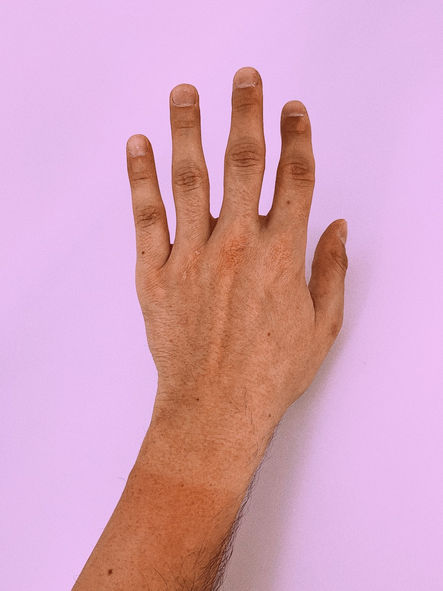 Photo Diagnosis of carpal tunnel syndrome