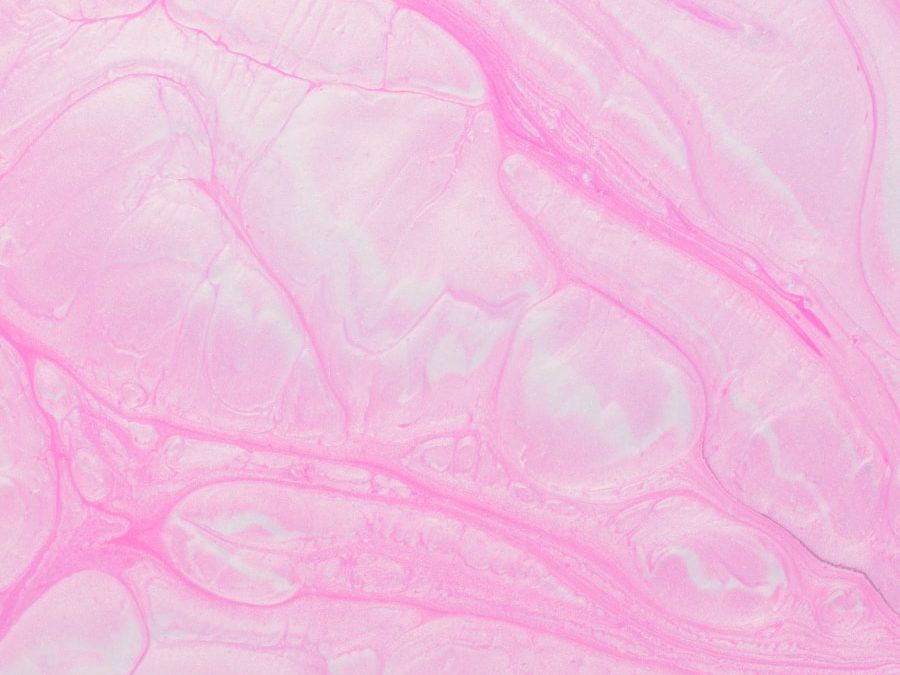 Photo Cardiac muscle tumor