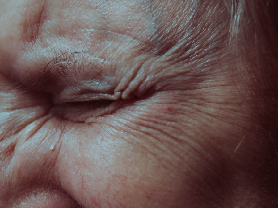 Photo Treatment of basal cell carcinoma