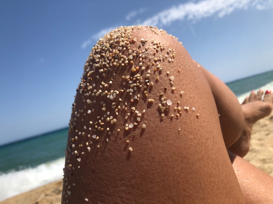 Photo Melanoma