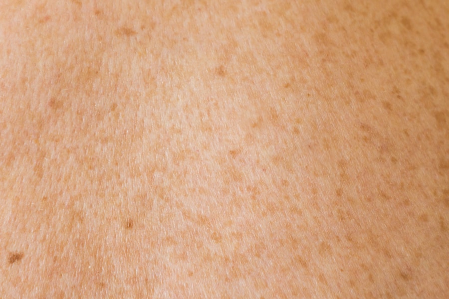 Photo Risk factors for skin cancer