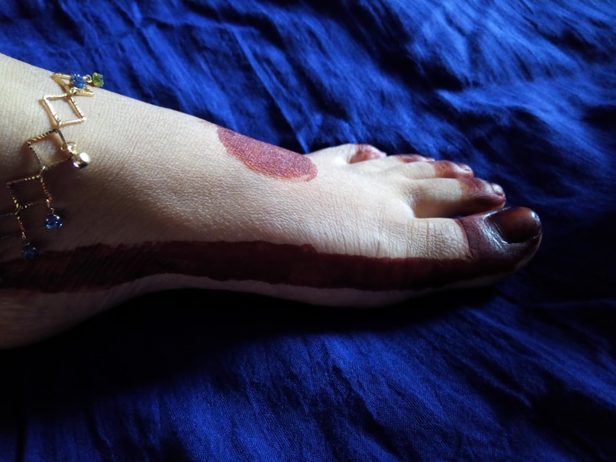 Photo Symptoms of cyanosis