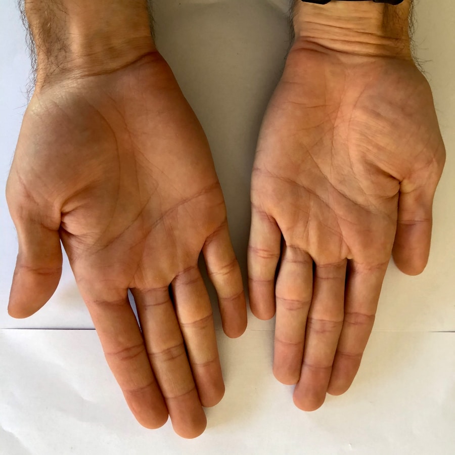 Photo Diagnosis of cyanosis