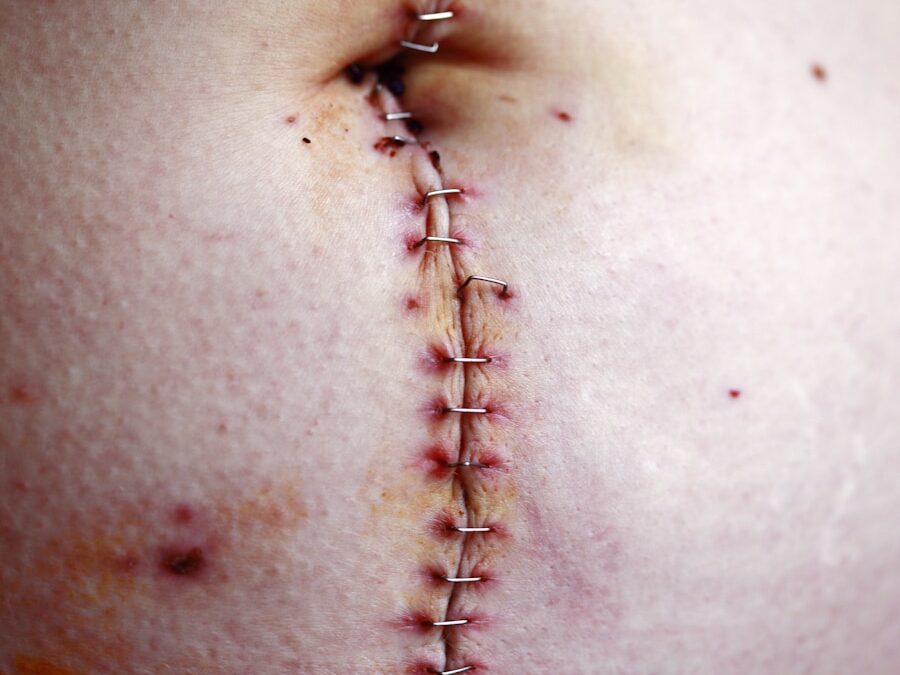 Photo Ulcerative colitis diagnosis