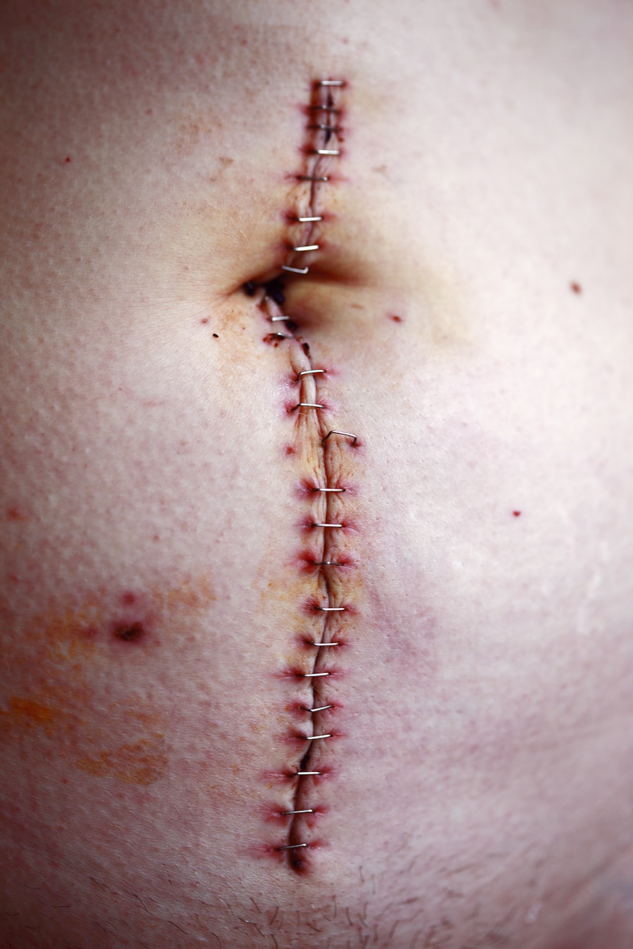 Photo Ulcerative colitis diagnosis