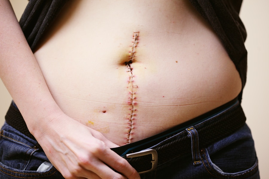 Photo "Complications of ulcerative colitis"