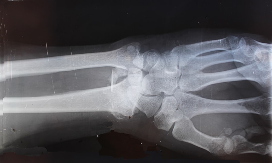 Photo Types of bone fractures