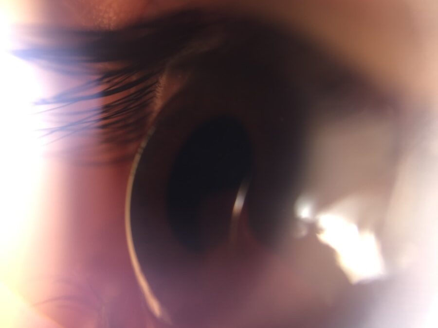 Photo "Diagnosis of tympanic membrane perforation"