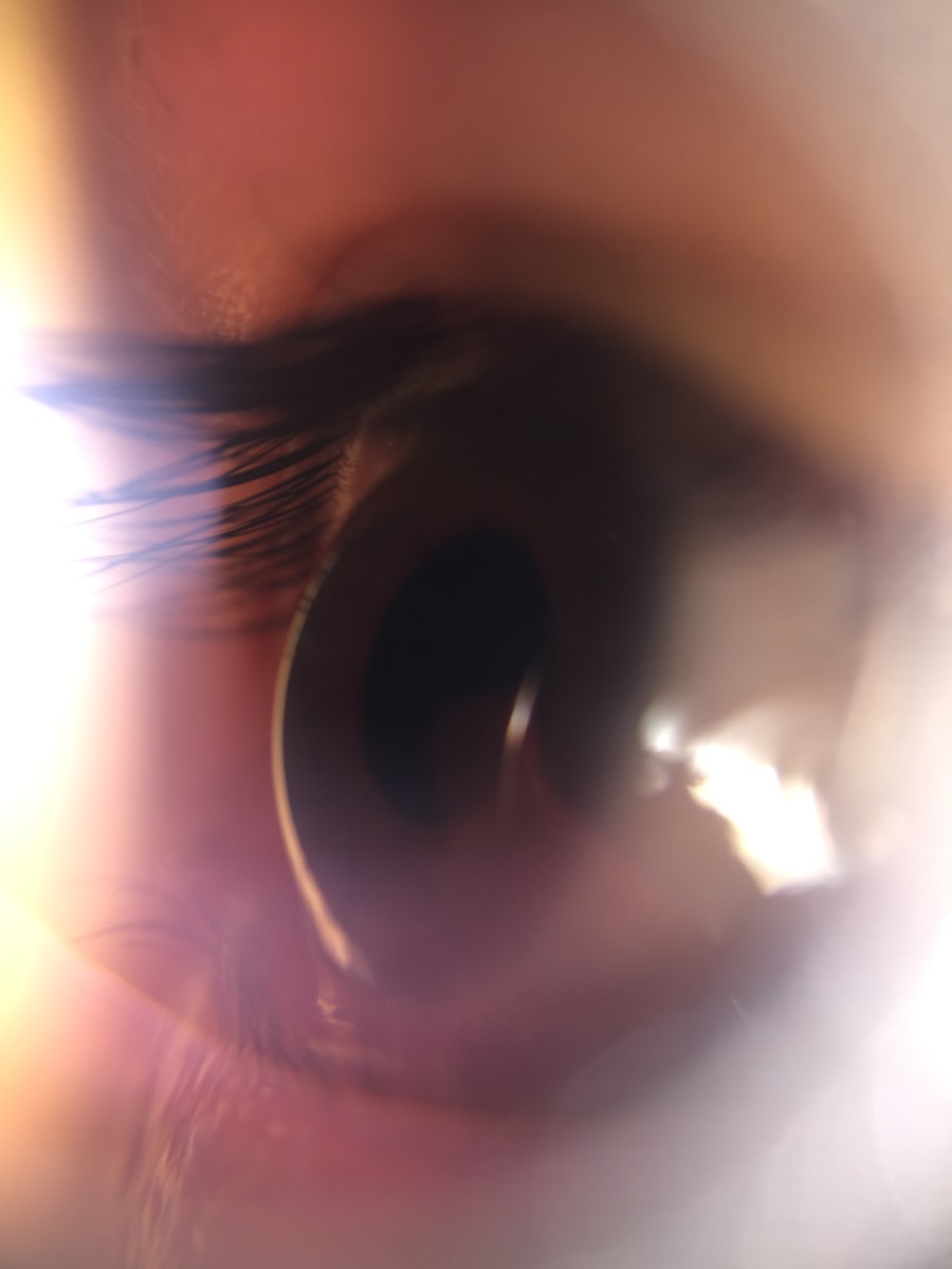 Photo "Diagnosis of tympanic membrane perforation"