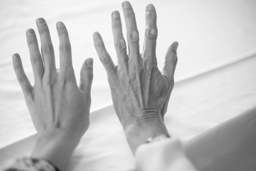 Photo Treatment of Dupuytrens contracture