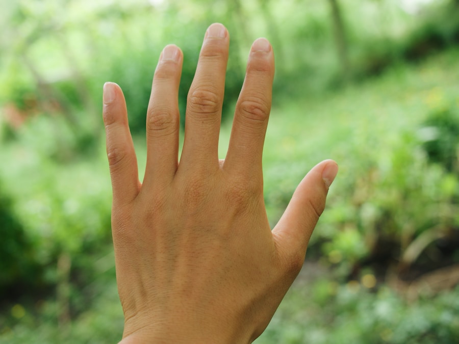 Photo Symptoms of Dupuytrens contracture