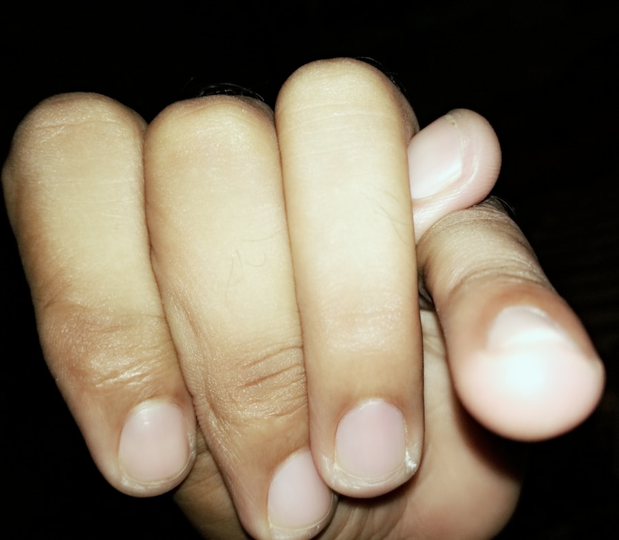 Photo "Causes of Dupuytrens contracture"