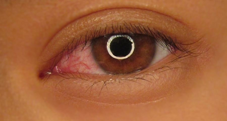 Photo Symptoms of phenylketonuria