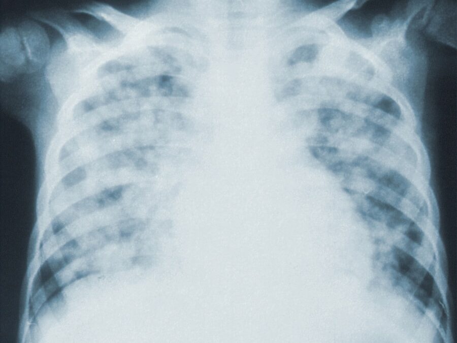 Photo "Diagnosis of tetralogy of Fallot"