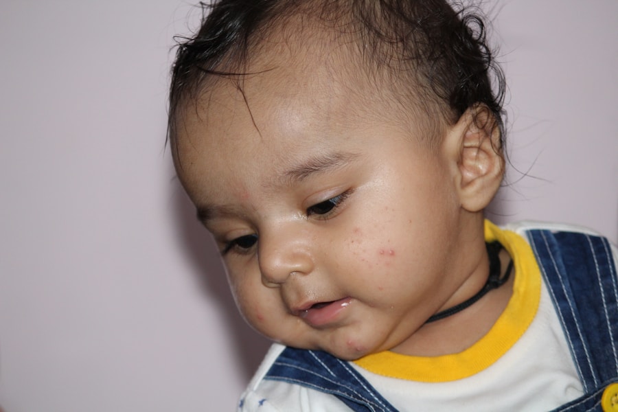 Photo Diagnosis of fibrous dysplasia