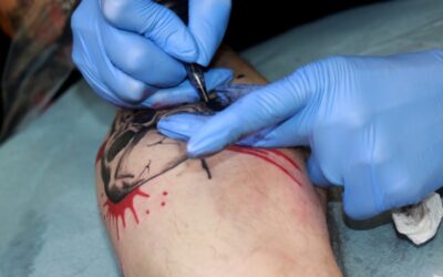 Photo Tartar removal