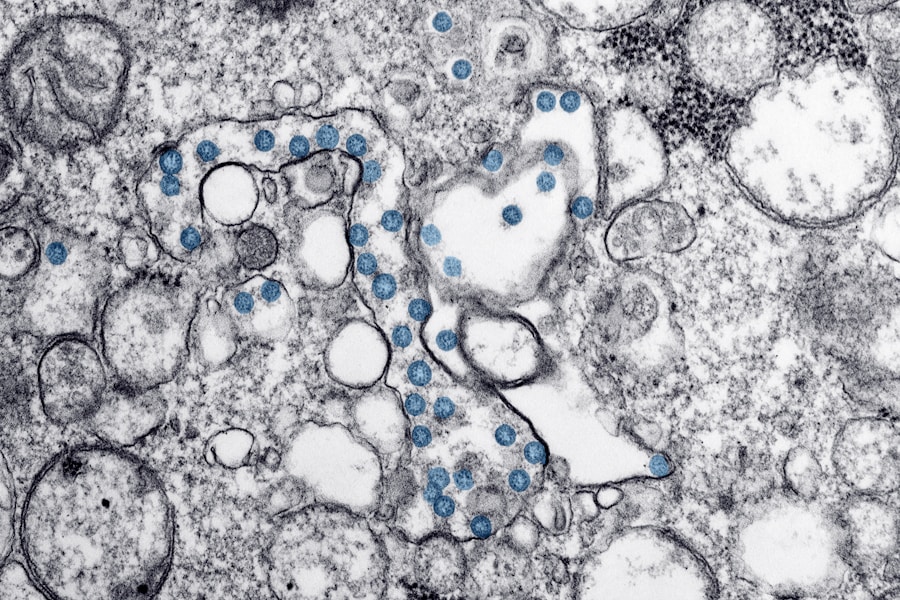 Photo Genetic background of Gaucher disease