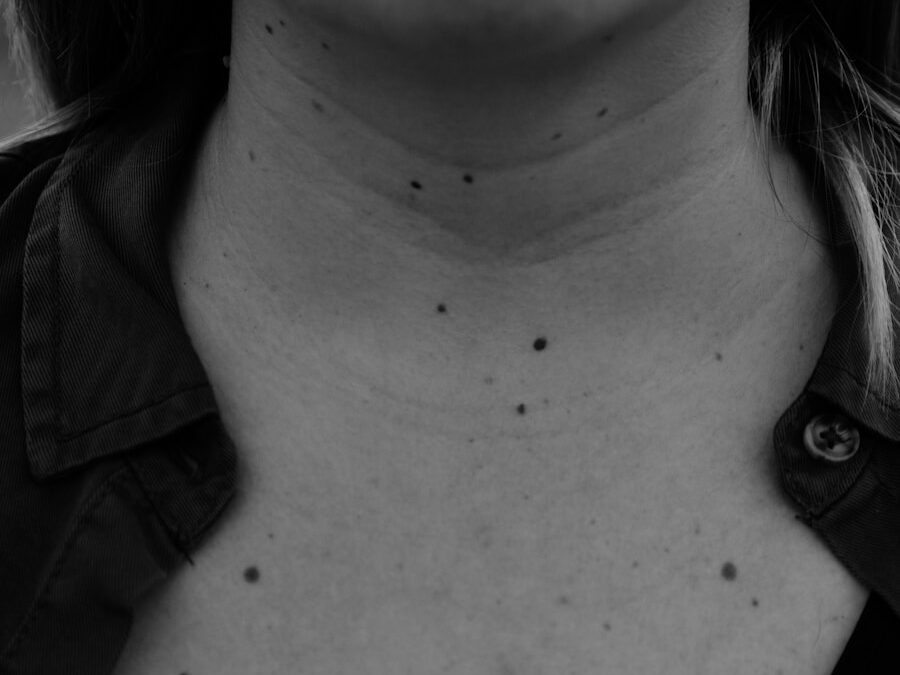 Photo Fordyce Spots