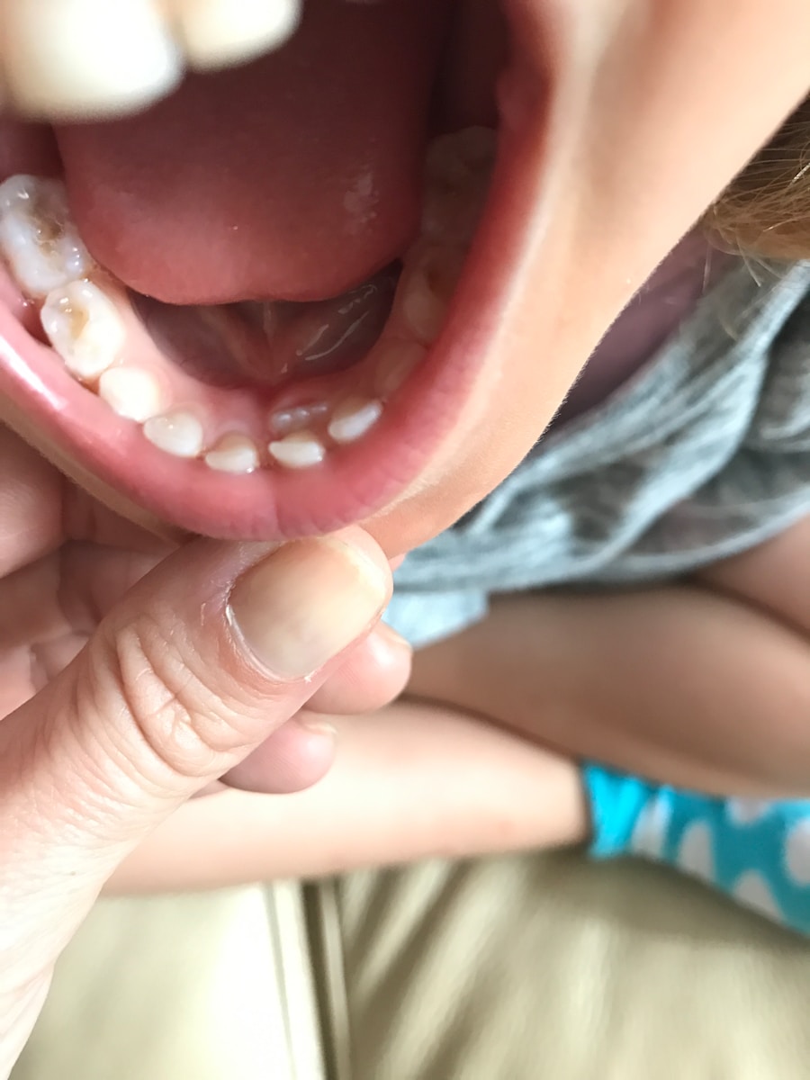 Photo "Fordyce spots on the mouth"