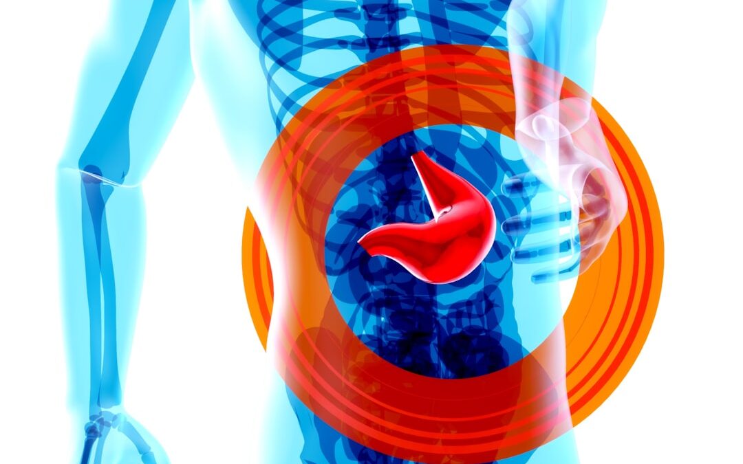Photo Stomach ulcer
