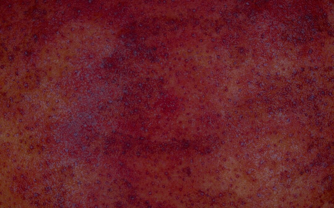 Photo Red rash