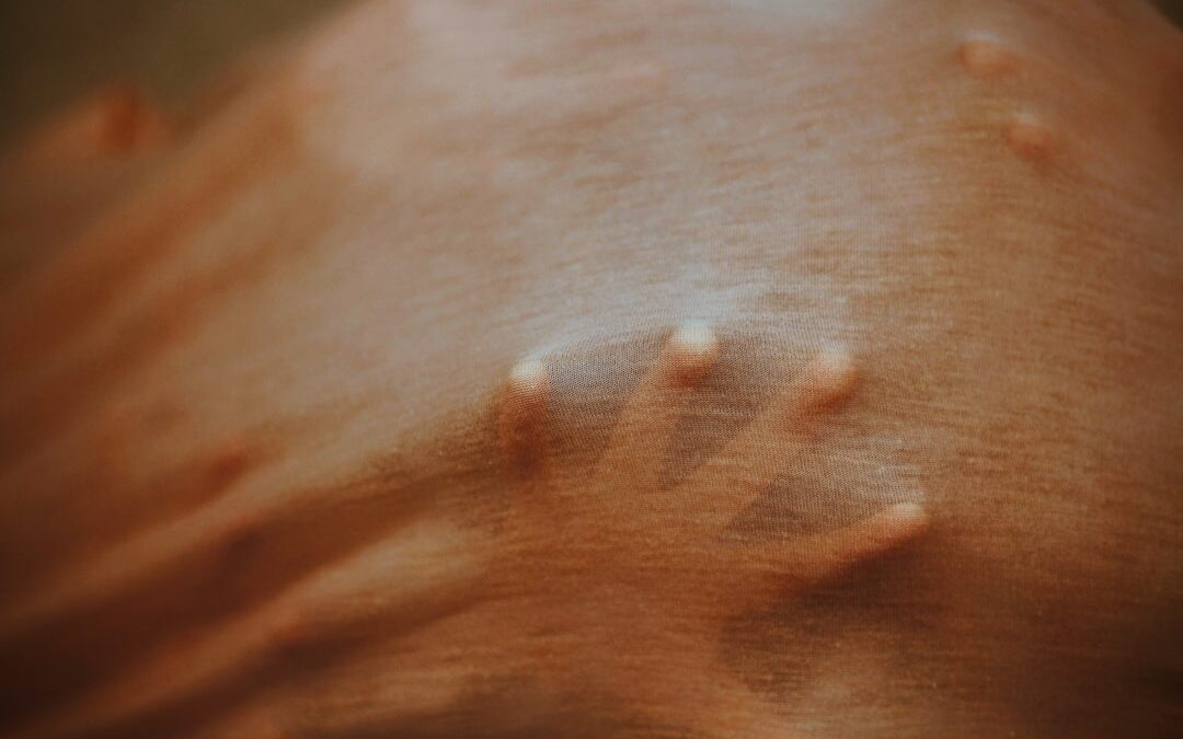 Photo Skin inflammation