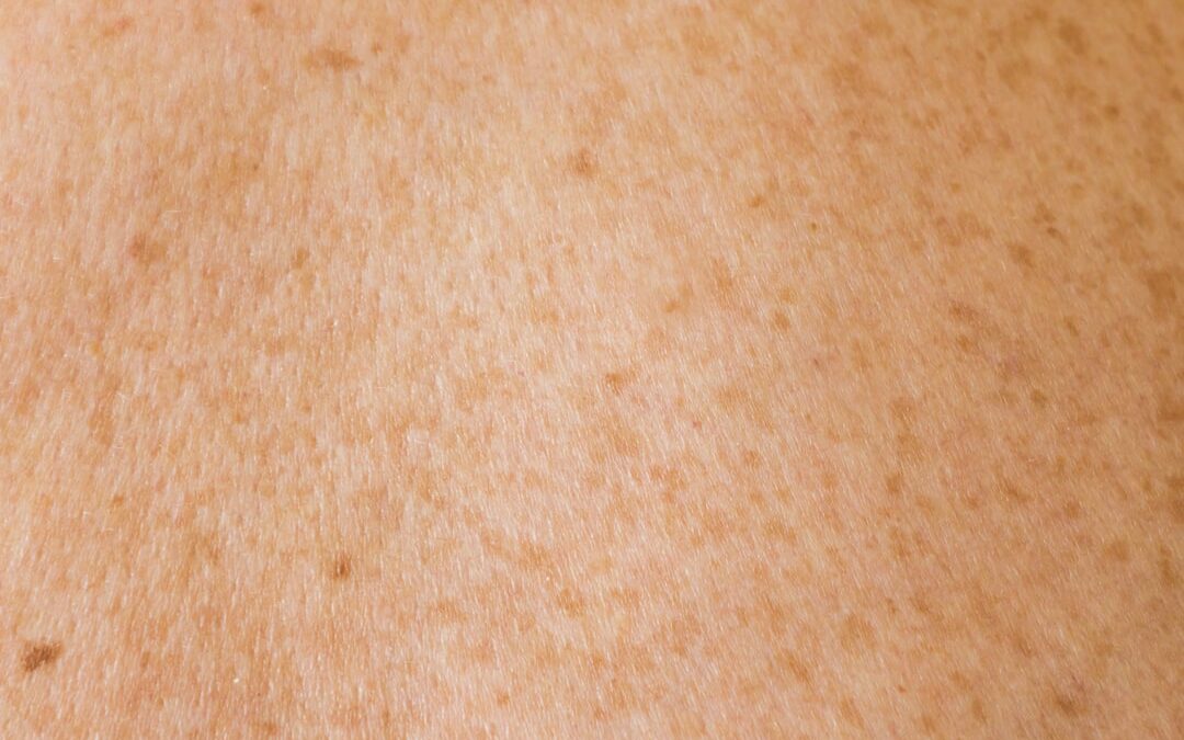 Photo Skin rash