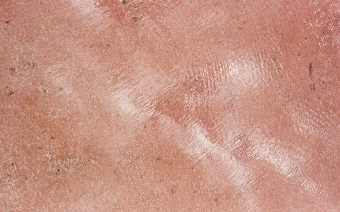 Photo Sunburned skin