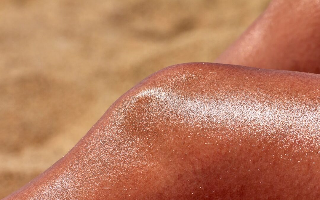 Photo Sunburn relief