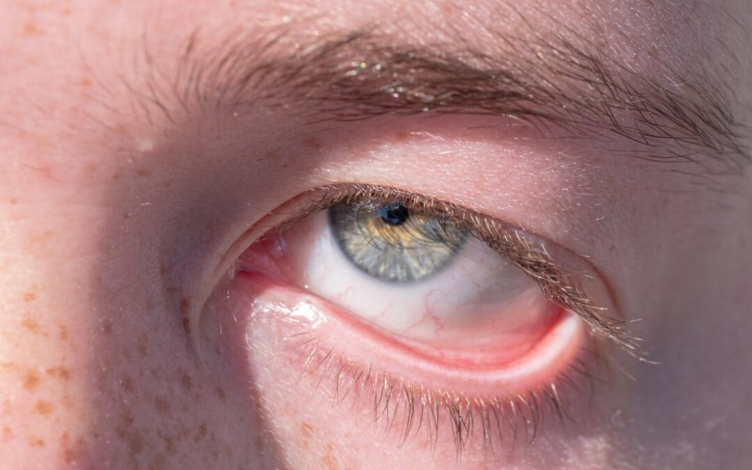 Photo Eye tumor