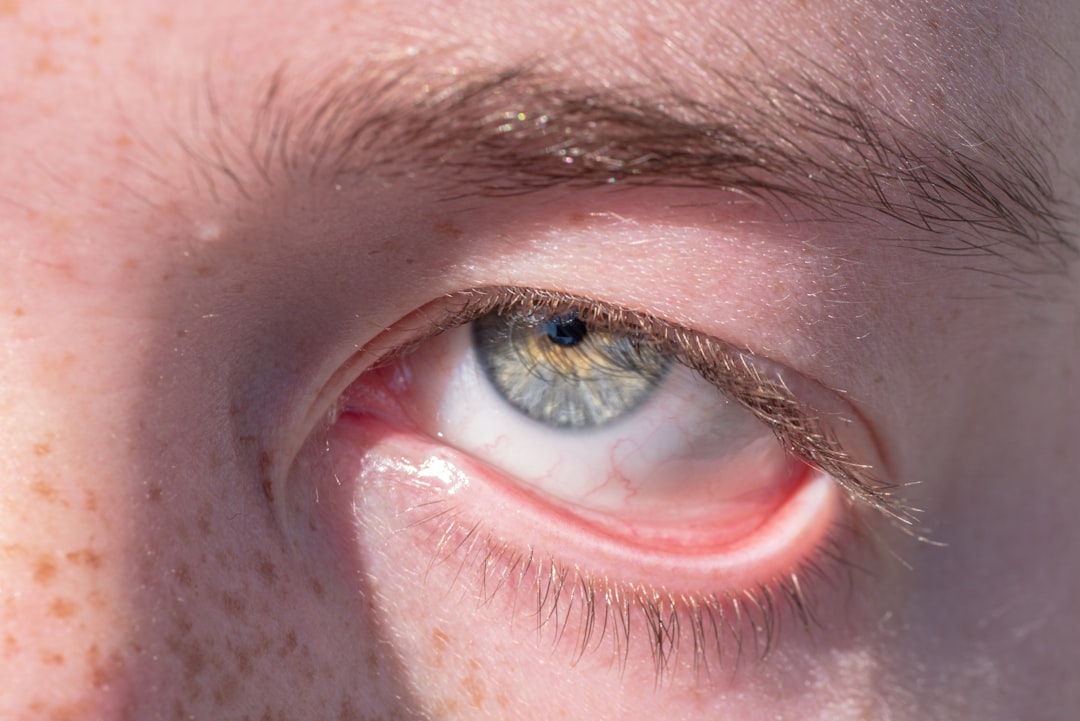 Photo Eye redness