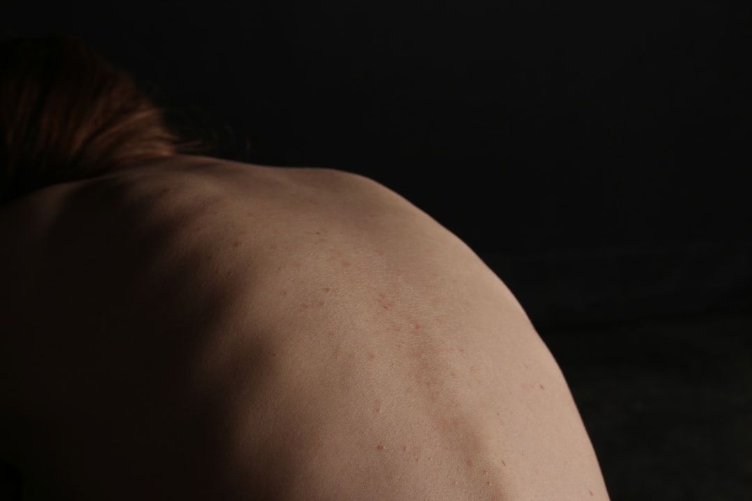 Photo Stretch marks