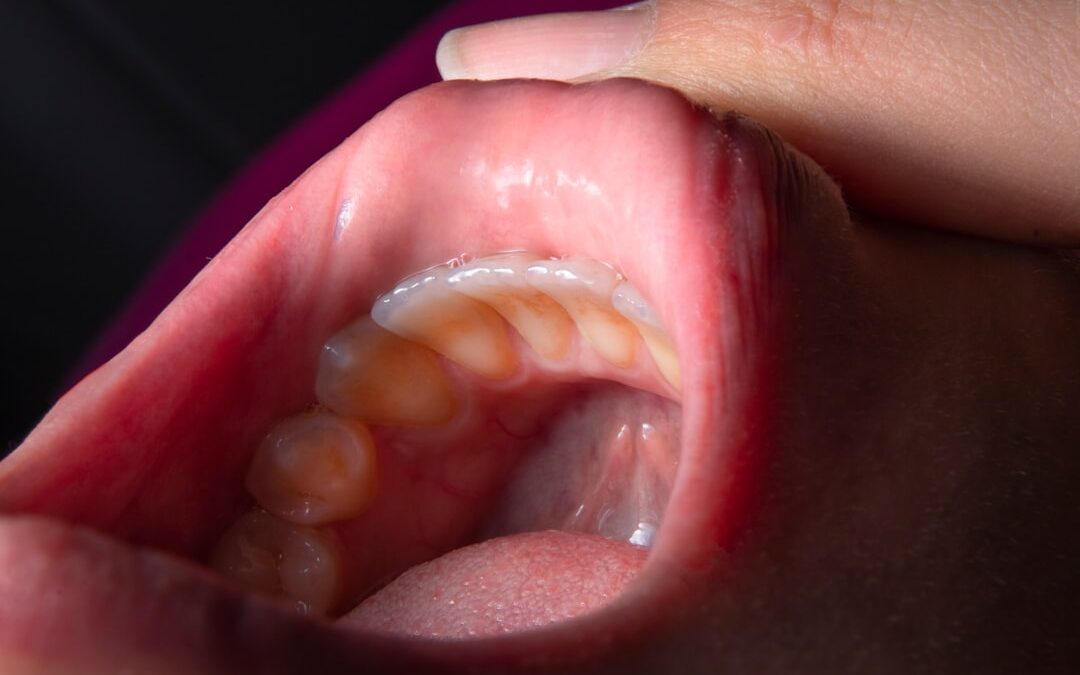 Photo Oral Cancer Screening